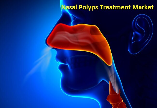 Nasal Polyps Treatment Market Forecasting Research Report with Major Aspects Like – Top Players Sanofi, F. Hoffmann-La Roche Ltd, Blacksmith Surgical, Pfizer Inc., Bausch Health,